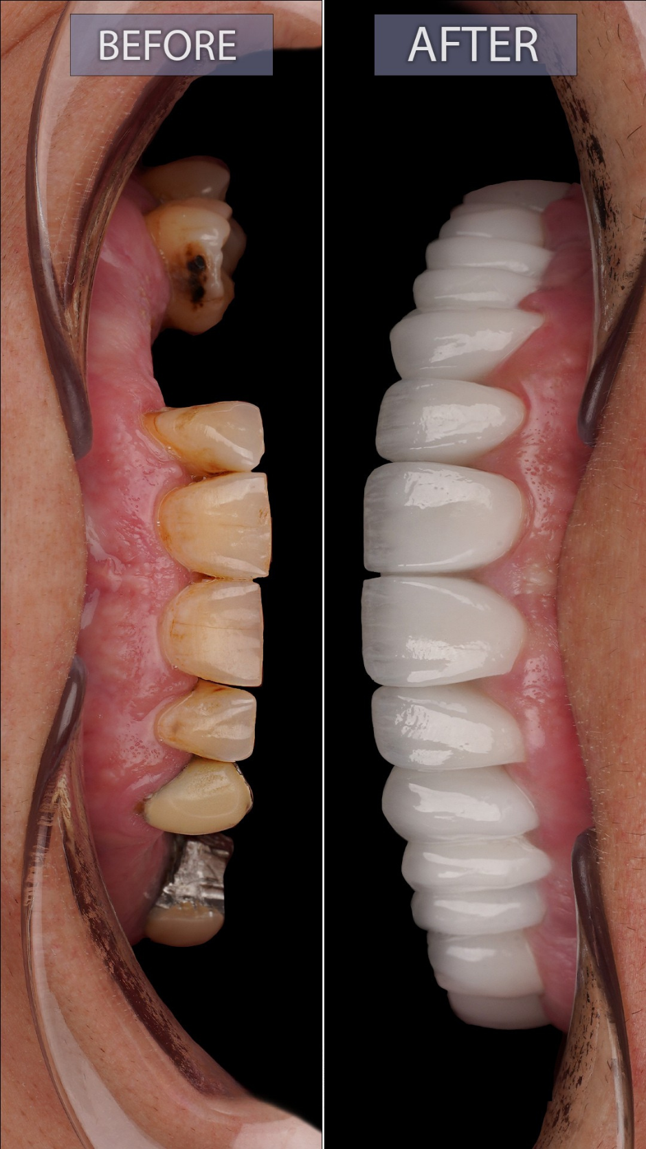 Before and after smile transformation — Patient Result 2