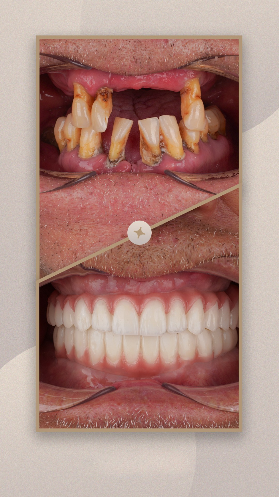 Before and after smile transformation — Patient Result 3